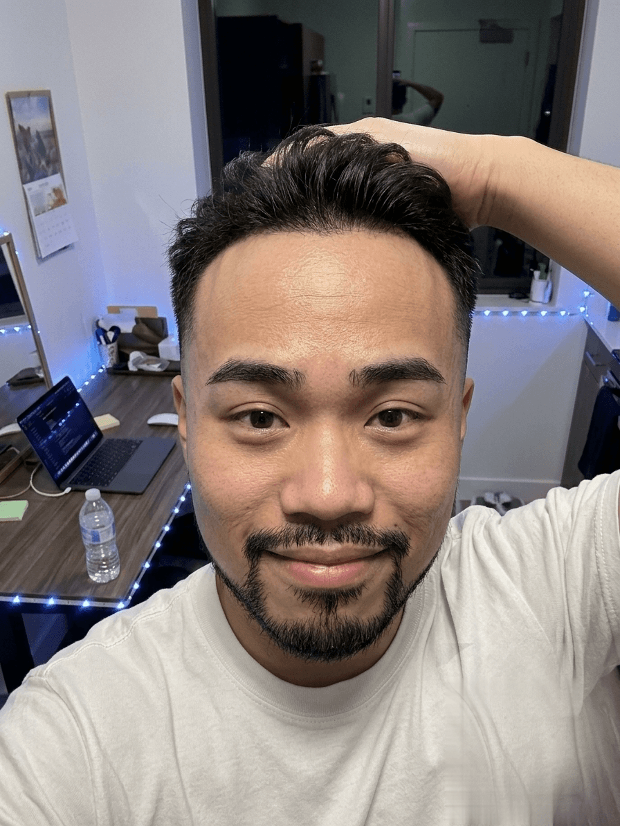 Photo after: hairline recovered, higher HairCount