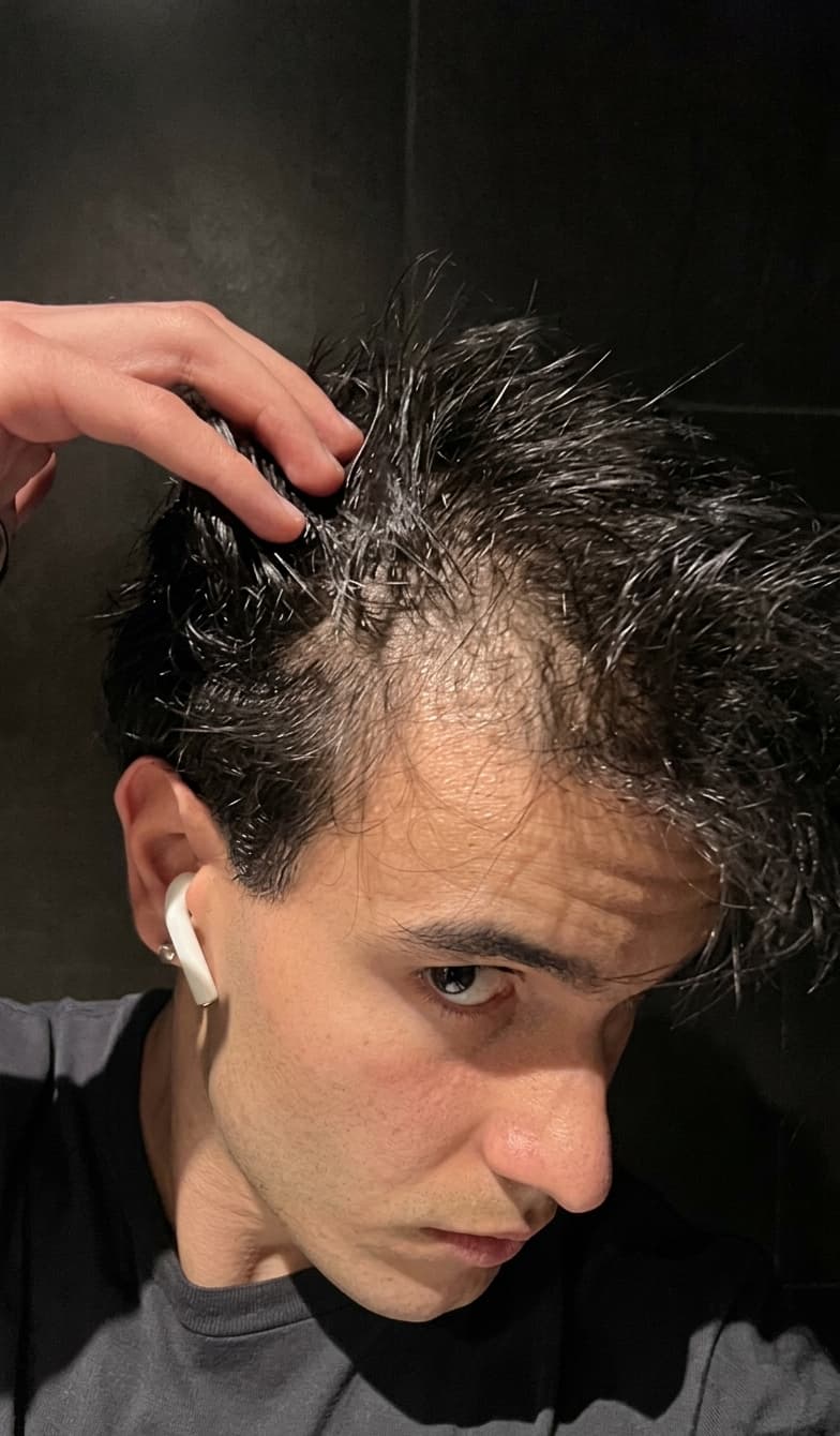 Photo before: visible hair loss along the frontal hairline